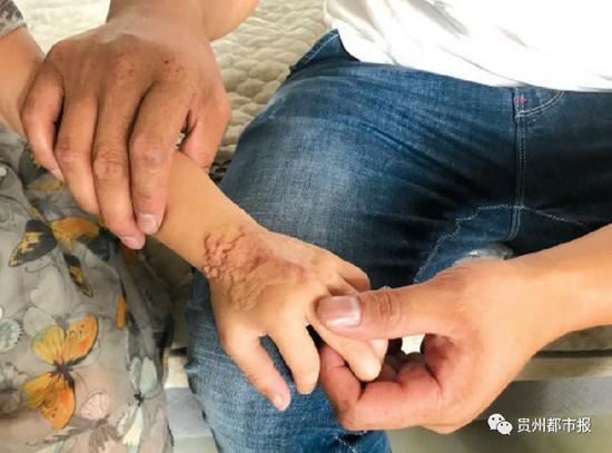 术后纱布留体内11年致女子九级伤残术后纱布留体内长达十一年，女子遭受九级伤残的悲剧警示